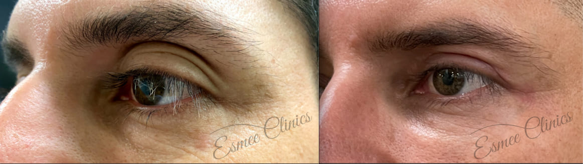 Before and After img